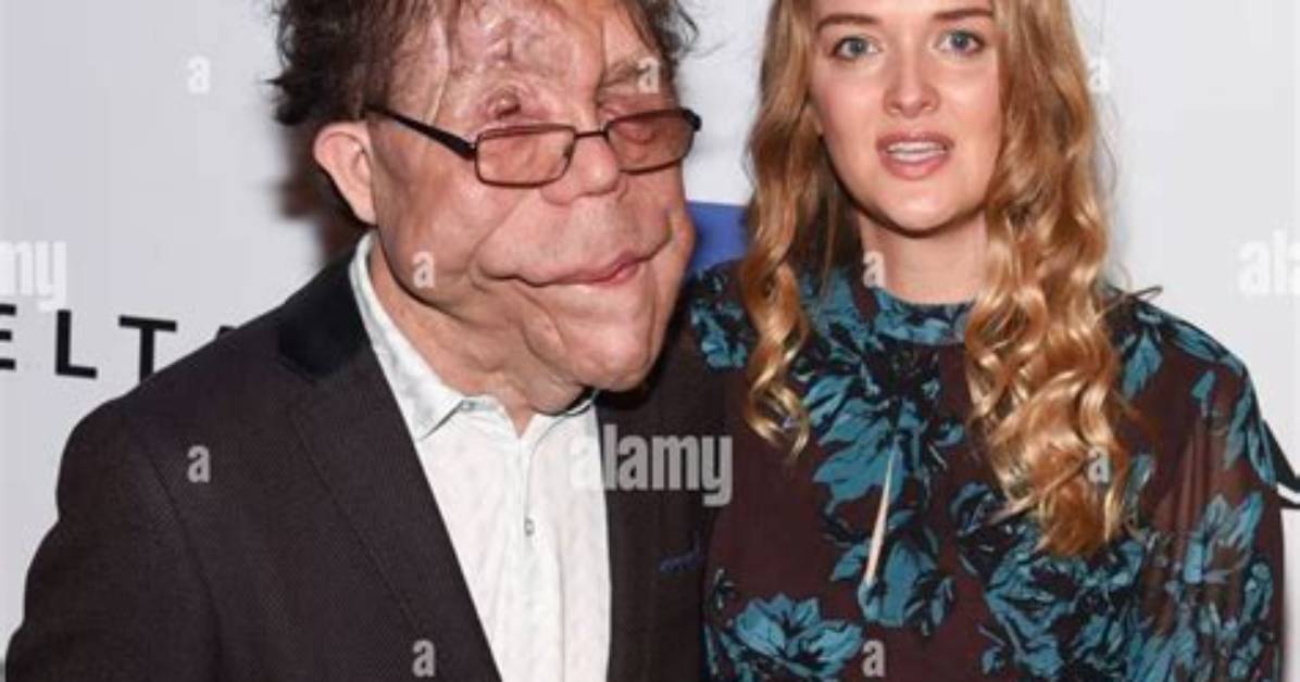 Adam Pearson Girlfriend: a Deep Dive into His Personal Life