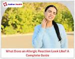 Allergic Reaction to Cinnamon: a Closer Look