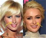 Did Paris Hilton's Plastic Surgery Make Her Look Better or Worse?