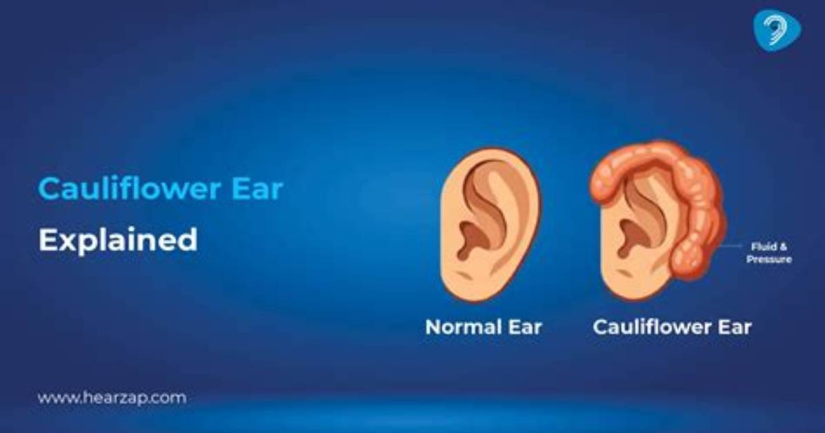 How to Avoid Cauliflower Ear: Prevention Tips and Techniques