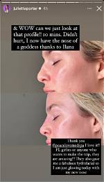 Juliette Porter Plastic Surgery Explained: Nose Job, Teeth Veneer and More