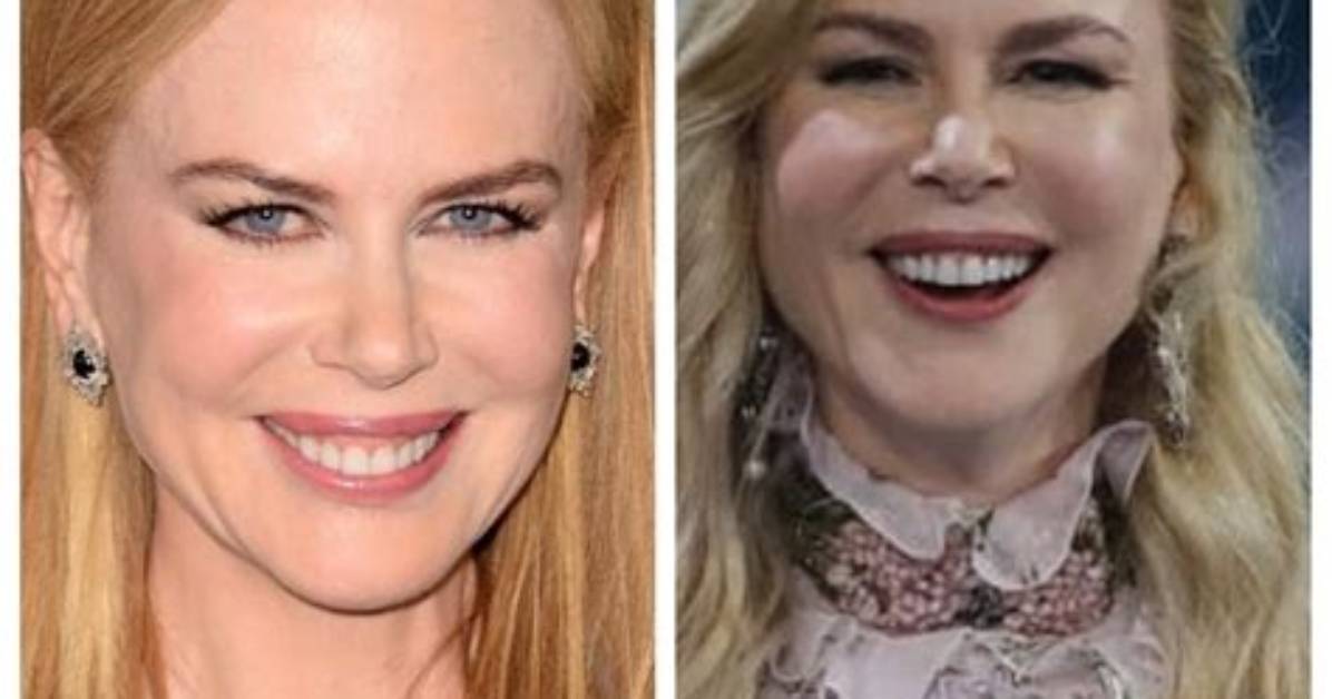 Kidman Surgery: Uncovering the Truth About Her Procedures