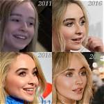 Sabrina Carpenter Lip Fillers: Enhancements or Natural Beauty?