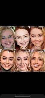 Sabrina Carpenter's Lip Filler: Exploring the Transformation