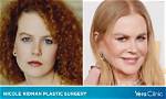 Surprising Truth About Nicole Kidman's Plastic Surgery