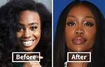Sza's Journey Before Plastic Surgery