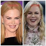 The Truth About Nicole Kidman's Surgeries: the Complete Guide