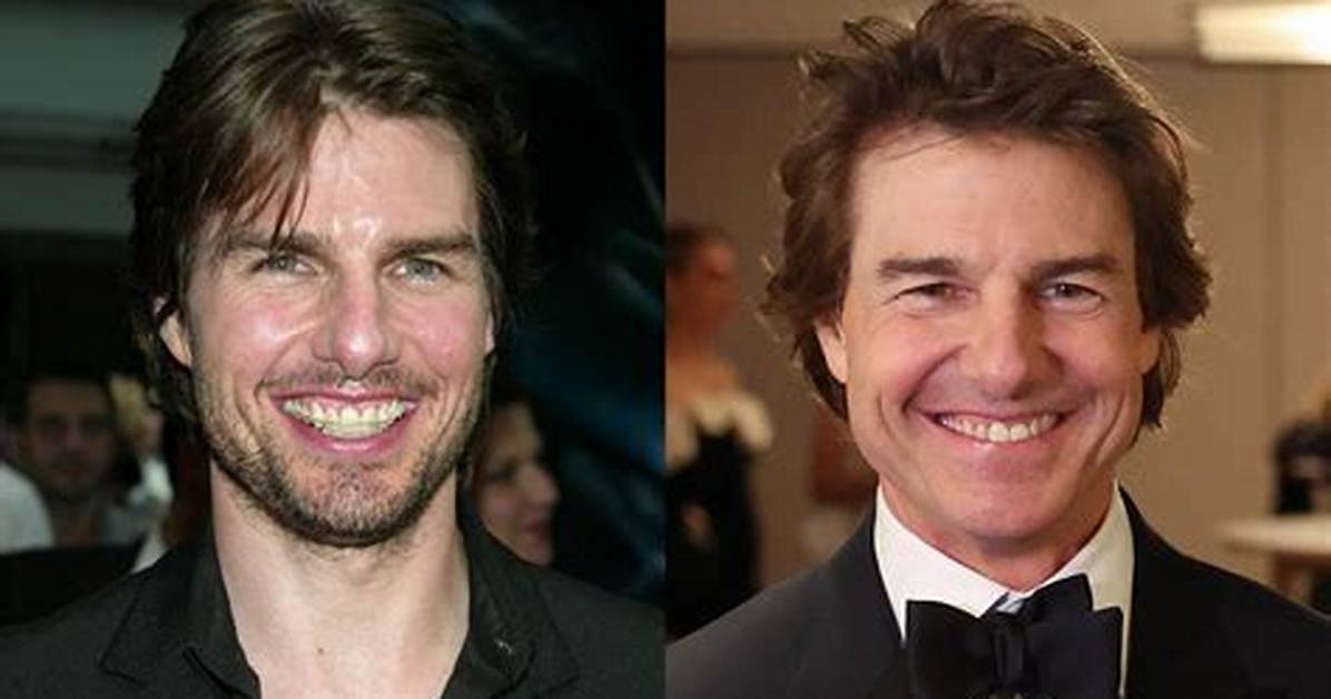 Unique Smiles: Exploring Actors with Underbites