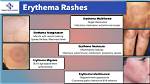 Unlock the Secrets of Diffuse Mildly Erythematous Mucosa: Discoveries and Insights