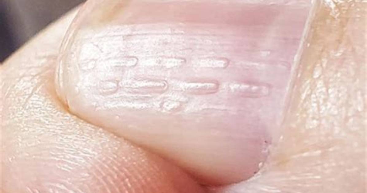 Unveiling the Mystery Behind Horizontal Ridges on Nails