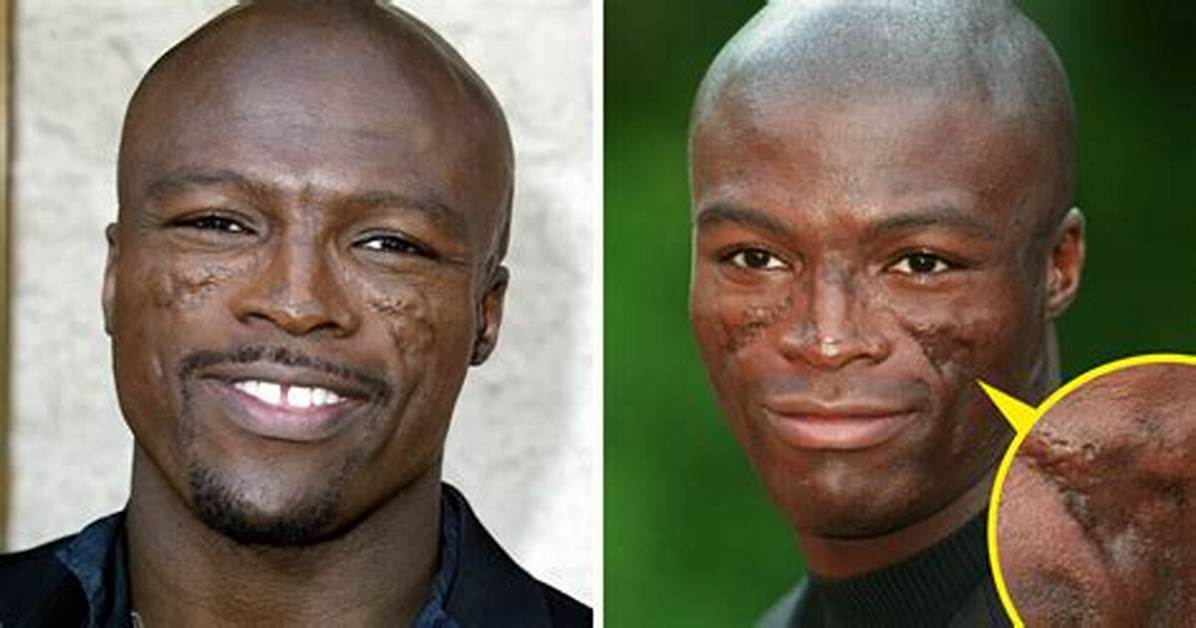 What Happened to Seal on His Face? Know About Seal Musician Face, Seal Face Scar